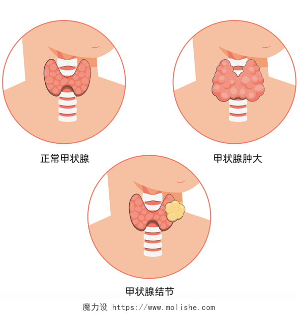 甲状腺三种形态甲状腺疾病扁平元素插画世界甲状腺日